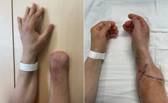 Руки пациента до и после трансплантации. Фото Департамента здравоохранения Москвы